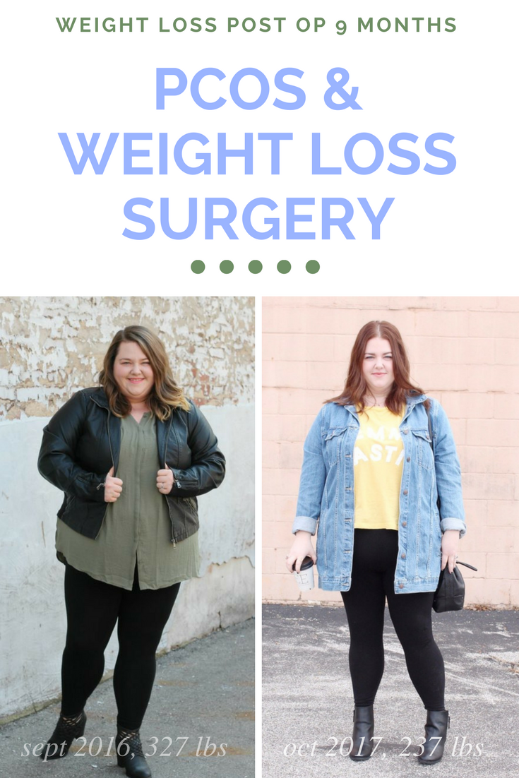 pcos-weight-loss-surgery-blog-dandk